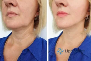 Double chin before and after Hi-Fu treatment 4 Book your double chin treatment Sleaford today! We are here to help!