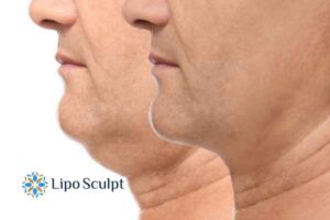 Double chin before and after Hi-Fu treatment 2 Double chin treatment Sleaford from Lipo Sculpt - feel more confident today!