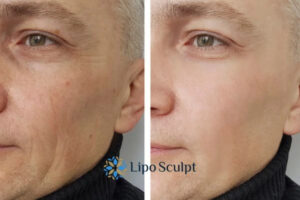 How to Fight Aging Symptoms 3 Fight Aging Symptoms Sleaford With HIFU and Morpheus8 Today!