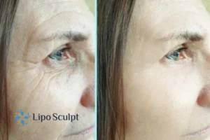 How to Fight Aging Symptoms 2 Do you want to Fight Aging Symptoms Sleaford? Contact Lipo Sculpt today!