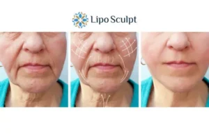 Explaining Morpheus8 And What It Can Do For You 3 Boost your confidence with Morpheus8 Sleaford call our team today!