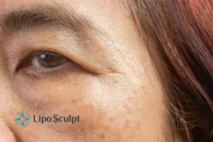 Cryopen: The Revolutionary Treatment for Age Spots Unveiled 2 Are age spots Sleaford giving you low self esteem? Contact us today!