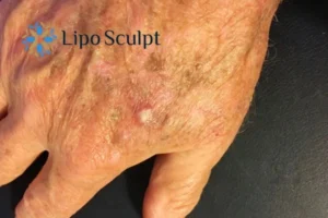 Best Actinic Keratoses Removal 2 Improve your wellbeing and health with Actinic Keratoses Sleaford removal.treatment